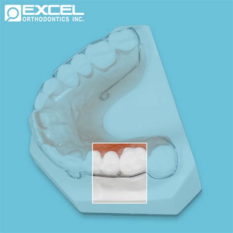 Clasp Options Excel Orthodontics