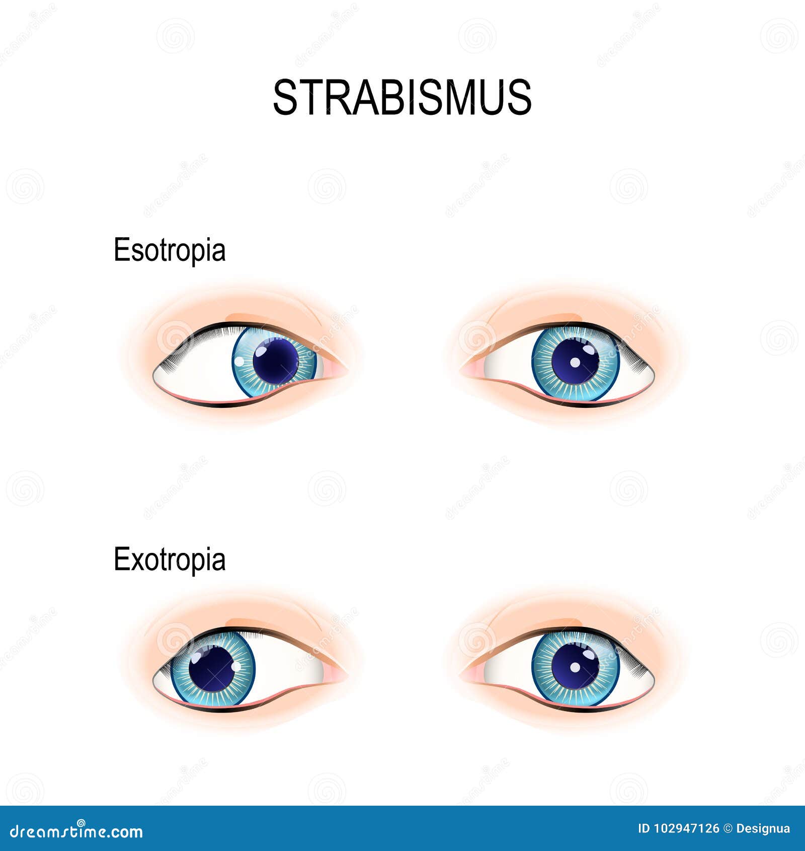 Types Of Strabismus Eyes With Esotropia Exotropia Hypertropia And